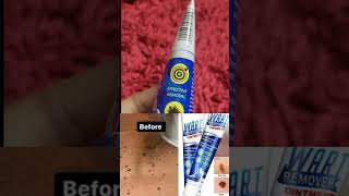 Salicylic acid wart removal  Does wart removal really work  Honest Review [upl. by Maletta]