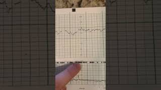 Non Stress Test or Fetal Heart Tracing 27 weeks brief explanation shorts nurses nurse [upl. by Carlotta]