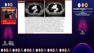 HIGH RISK PULMONARY EMBOLISM [upl. by Asenaj698]