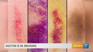 Why bruising matters and what the purple blue and yellow marks can indicate [upl. by Tesil344]