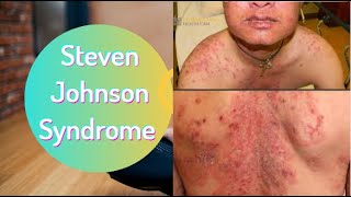 Steven Johnson Syndrome  SJS  PhysiotherapyKnowledge [upl. by Garap962]