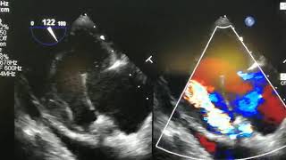 Severe AR due to Paravalvular leak after AVR [upl. by Eralc484]