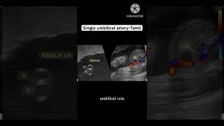 SUA single umbilical artery என்றால் என்ன இது குழந்தையை எவ்வாறு பாதிக்கிறது tamil [upl. by Tega]