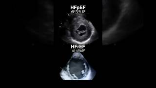 Echocardiogram HFpEF vs HFrEF radiology cardiology [upl. by Aretta]