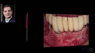 Peri Implantitis Diagnosis Etiology and Treatment [upl. by Mellen851]