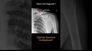 Clavicle fracture Undisplaced 102 Xray Upper limb Clavicle and AC jointradiologychannel007 [upl. by Ring]