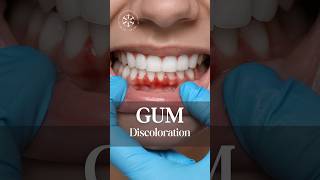 Transform Your Smile with Gum Depigmentation Dental Health enfieldroyalclinic gumdisease [upl. by Haymes186]