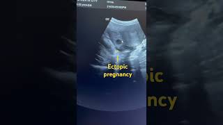 Ectopic pregnancy ectopicpregnancy uterus ultrasound obglife pregnancy ytshortshortbabyyt [upl. by Nasho]