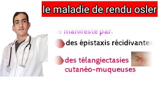 la maladie de renduosler [upl. by Yttak]