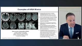 Drs Barakos amp Benzinger discuss AlzheimersDisease ARIA  httpsbitlyARIA24Y [upl. by Rosol]