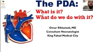 update on Neonatal PDA Management DrOmar Basem Elkhateeb [upl. by Elleirad527]