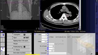 CT Scan angiography of the thoracic aorta SIEMEN  CLVT Động mạch chủ ngực [upl. by Immanuel]