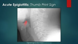 Acute Epiglottitis Thumb Sign [upl. by Haneehs]