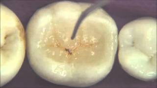 Procedimento de restauração estética em resina para dentes posteriores por Prof Dr Ronaldo Hirata [upl. by Yanrahc]