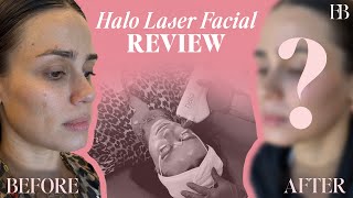 HOLY MOLY THE RESULTS OF THE HALO LASER FACIAL IS CRAZY [upl. by Marlow618]