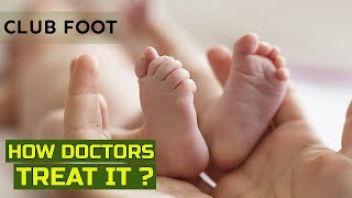 What is clubfoot and how is it treated  Nature Cure Fit [upl. by Shaylyn496]