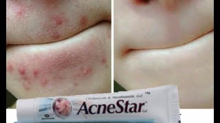 AcneStar Gel Remove Acne  Pimples  BlackheadsComplete Review हिन्दी मैं [upl. by Enecnarf]