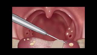 Tonsil Stone Removal Animation [upl. by Ahl]