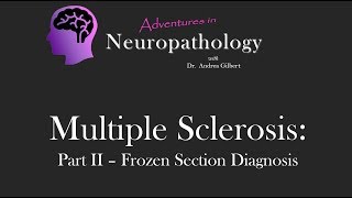 Multiple Sclerosis Part II Frozen Section Diagnosis  Adventures in Neuropathology [upl. by Lladnyk]