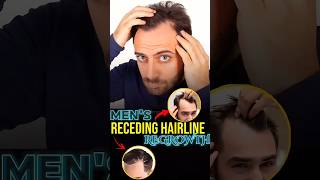 Receding Hairline regrowth derma roller hair mensgrooming [upl. by Lasky848]