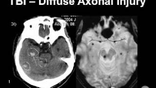 Diagnosing Brain Hemorrhages [upl. by Boor823]