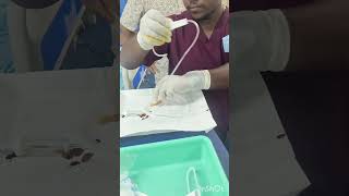 Asciticfluid tappingparacentesis medicostappingprocédure medicalstudentviralvideo paramedical [upl. by Winona]