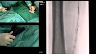 TSR SEGMENTAL RECANALIZATION WITH SUPERA STENTING OF SFA amp POPLITEAL ARTERY AND RECANALIZATION AND P [upl. by Nettirb]