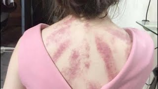 kerokanguasha kerokan cupping massage [upl. by Rola]