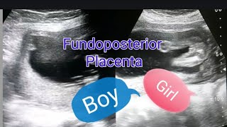 Fundoposterior placenta  Anterior placenta means baby boy  Posterior placenta means baby girl [upl. by Aineval]