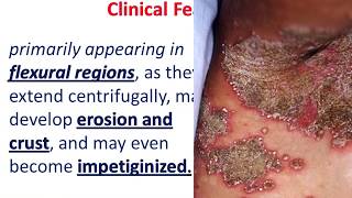 10 MIN REVISION impetigo Herpetiformis [upl. by Adyan]