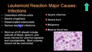 LEUKEMOID REACTION 4TH YR [upl. by Aneeres]