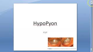 Ophthalmology 112 a HypoPyon Anterior Chamber Eye [upl. by Rieth943]