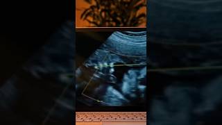 Miracle IVF Pregnancy Success Story ivfvideosinmalayalam ivfvideosforpregnancyinmalayalam [upl. by Inram587]