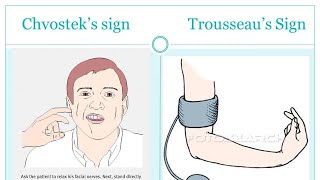 Trousseaus sign of latent tetany [upl. by Steffin]