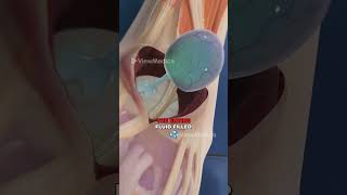 Ganglion Cyst Removal 3D Animation [upl. by Nance]