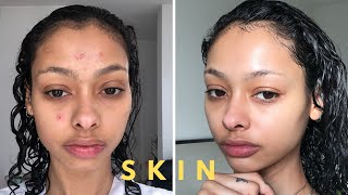 How my forehead acne cleared up [upl. by Durgy]