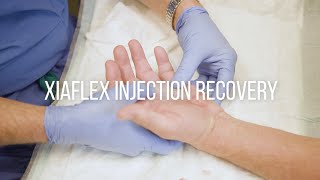 Dupuytrens Contracture Injection Recovery Instructions [upl. by Aramoix]