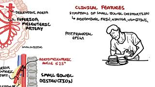 Superior mesenteric artery syndrome SMA Syndrome and Nutcracker Syndrome [upl. by Weaks]