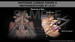 Posterior Lumbar Fusion amp Instrumentation at L5S1 [upl. by Ann]