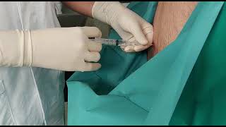 Procedure CFM  Spinal anaesthesia Anestesia spinale [upl. by Eeralih575]