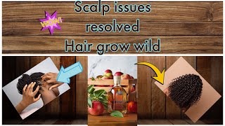 Dandruff gone  Only this no more scalp issues Scalp issues resolved [upl. by Attelahs]