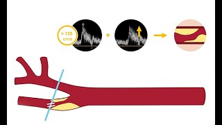 Identifying carotid artery disease with ultrasound [upl. by Acirea8]