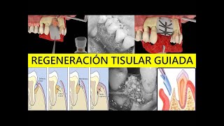 FUNDAMENTOS Y BASES QUIRÚRGICAS DE LA REGENERACIÓN TISULAR GUIADA RTG [upl. by Glick]