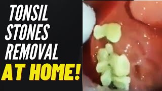 Tonsil Stones Removal Causes and Treatment [upl. by Ainiger839]