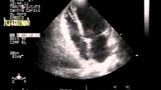 dissecting hematoma of the interventricular septum with biventricular apical small thrombi [upl. by Dimitry]