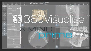 Acteon XMIND Prime General CBCT Overview of AIS 3D software [upl. by Plate402]