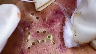 Big Cystic Acne Blackheads Extraction Blackheads amp Milia Whiteheads Removal Pimple Popping 086 [upl. by Thedrick928]