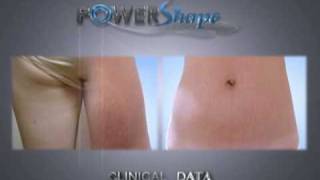 POWERSHAPE wwwpowershapecom non invasive body contouring using Rflaservacuum [upl. by Bik708]