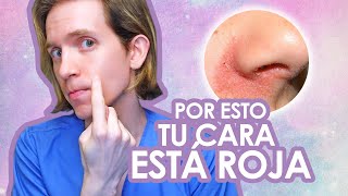 DERMATITIS SEBORREICA Qué es y cómo se trata  Recomendaciones de un dermatologo [upl. by Ahsaenat]