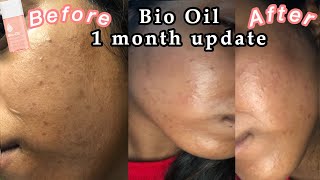 Bio oil review before and after  1 month face update [upl. by Reinnej]